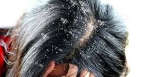 وصفة
      طبيعية
      لعلاج
      قشرة
      الشعر
      بشرط
      المواظبة
      عليها